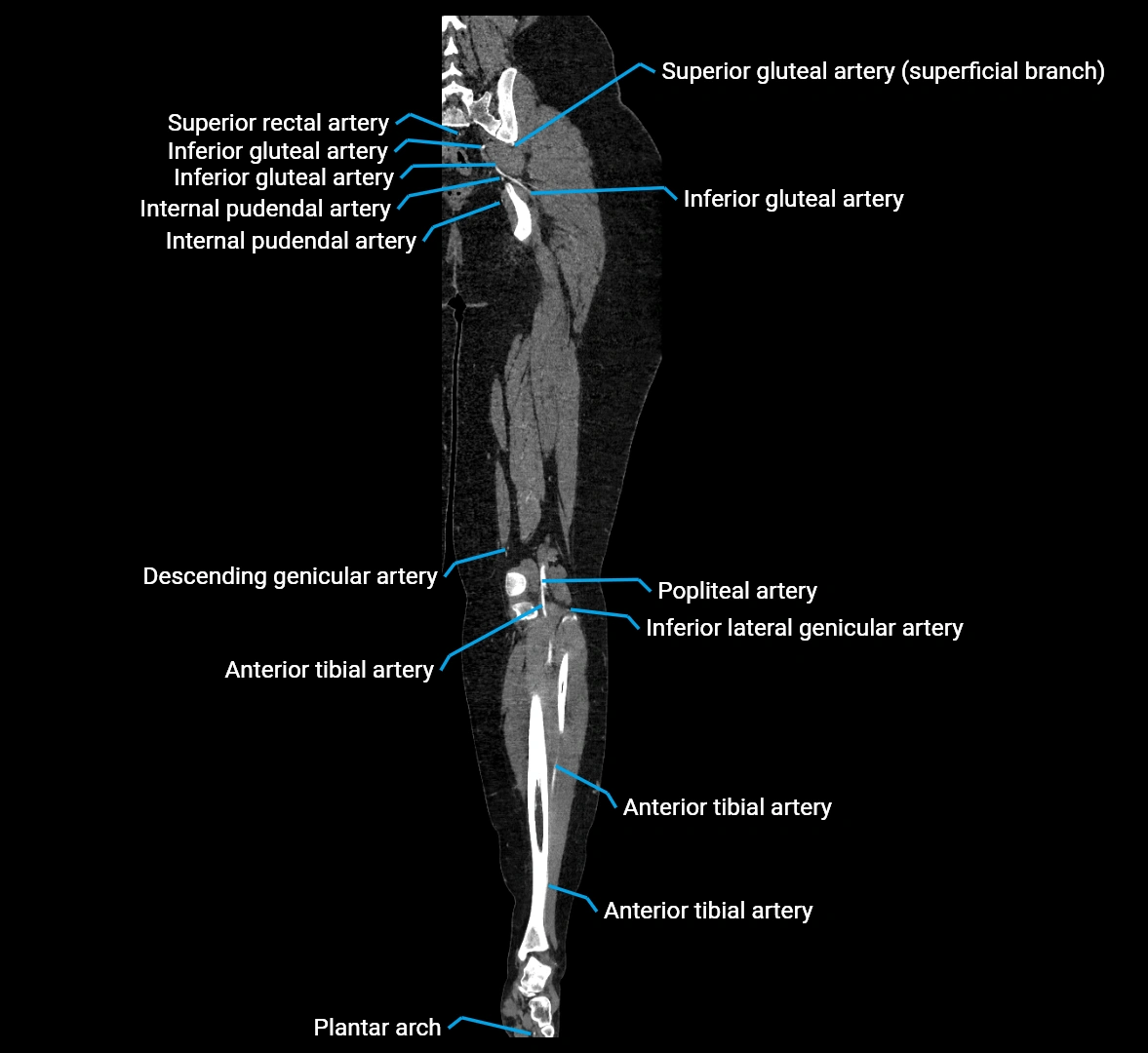 CTA lower limb coronal cross sectional anatomy labelled image _60 (2).webp